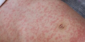 Measles Outbreak Declared in Montgomery County and Two Other Maryland Counties